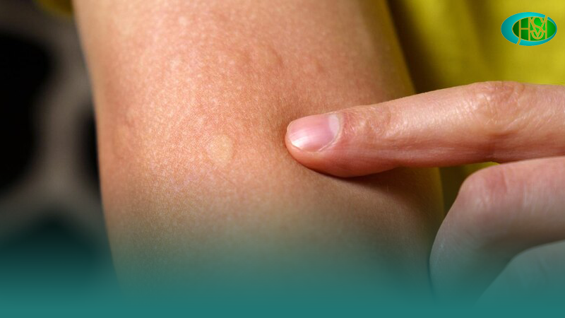 کهیر-پوستی-خطرناک-است